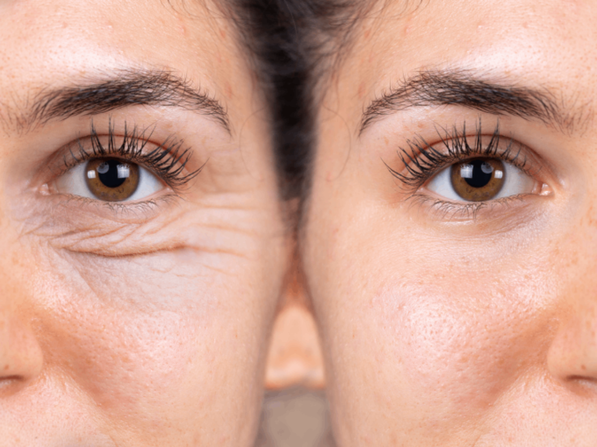 ridurile de sub ochi (plasă cum se îndepărtează crema reparatoare ADN cosmesis anti imbatranire