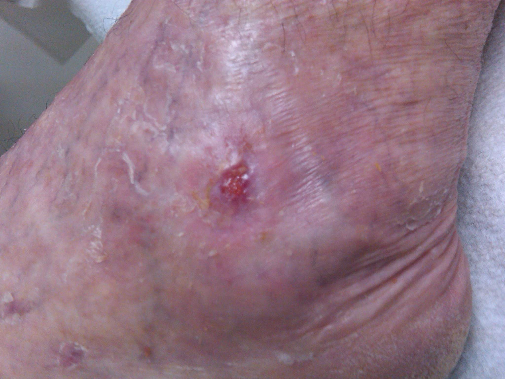 7 sfaturi pentru a preveni si a trata ranile diabetice