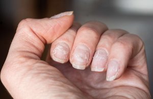 Tratamente naturiste pentru unghii fragile – Remedii eficiente și sfaturi de îngrijire