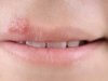 Herpes bucal (herpes oral): Cauze, declanșatori și cele mai eficiente remedii naturale