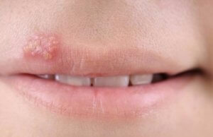 Herpes bucal (herpes oral): Cauze, declanșatori și cele mai eficiente remedii naturale
