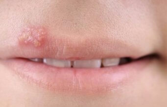 Herpes bucal (herpes oral): Cauze, declanșatori și cele mai eficiente remedii naturale
