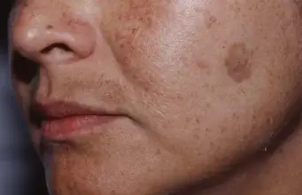 Tratamente naturiste pentru afecțiunile pielii: alunițe, negi, excrescențe cutanate și pete de vârstă