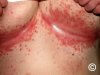 Cum să scapi de erupția cutanată sub sâni: 10 remedii naturiste și sfaturi | Ghid complet