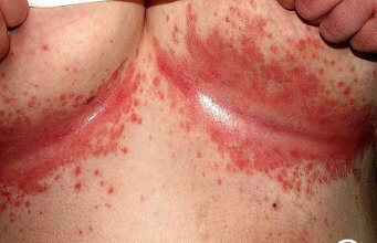 Cum să scapi de erupția cutanată sub sâni: 10 remedii naturiste și sfaturi | Ghid complet